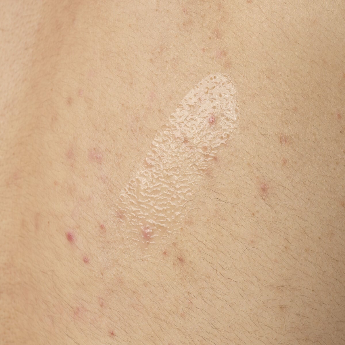salicylic-acid-0-5-body-serum-b4 ORD-salicylic-acid-05-body-240ml-application.jpg