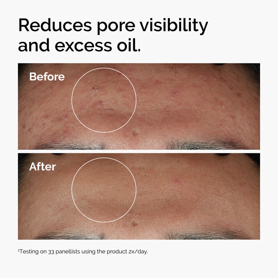 niacinamide-10-zinc-1-j6 ord-niacinamide-zinc-blemish-serum-before-after-pores.jpg