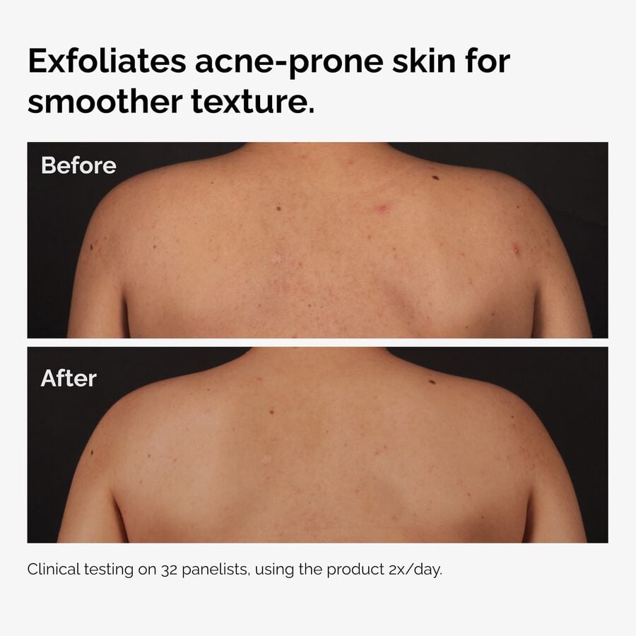 salicylic-acid-0-5-body-serum-b4 ord-salicylic-acid-body-serum-before-after-graphic-NA.jpg