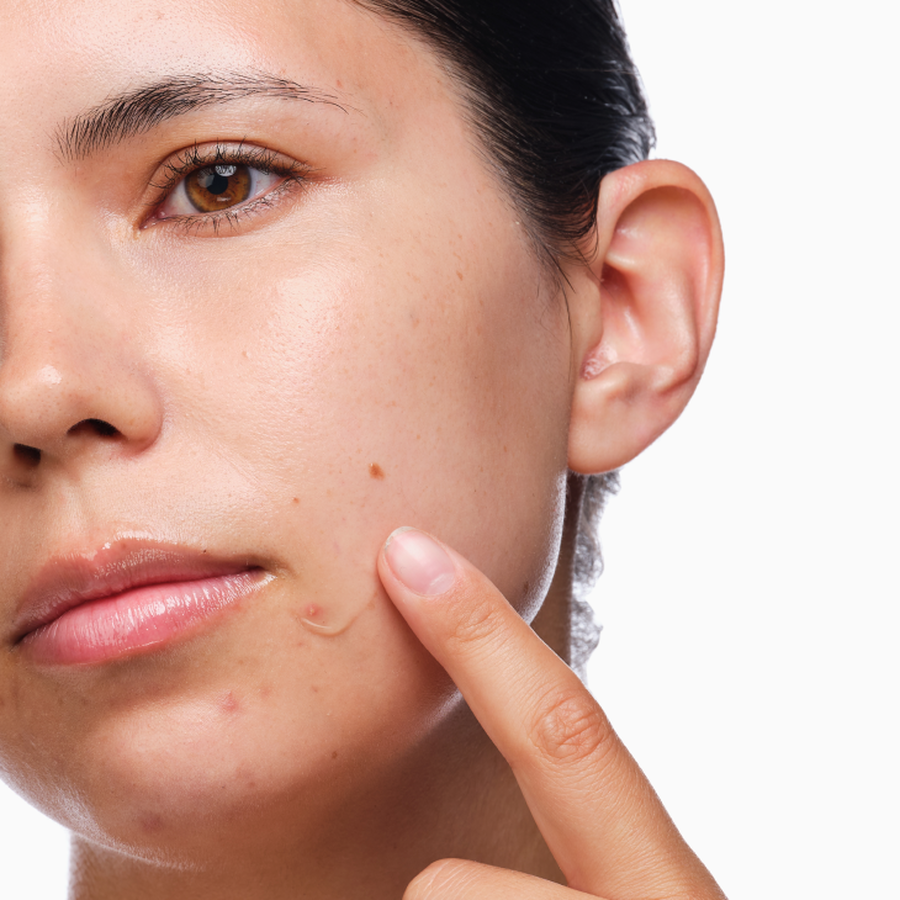 the-acne-set-g5 rdn-the-acne-set-application.png